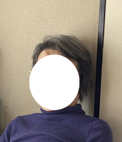 松葉茶を飲み続けている85歳母の正面から見た髪の状態
