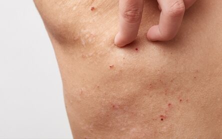 汗がこもりやすい夏の背中のあせも